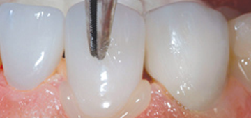 Les types des prothèses dentaires